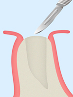 1：歯の欠損がある状態です。