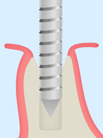 2：顎の骨に人工歯根を埋め込む穴を開けます。